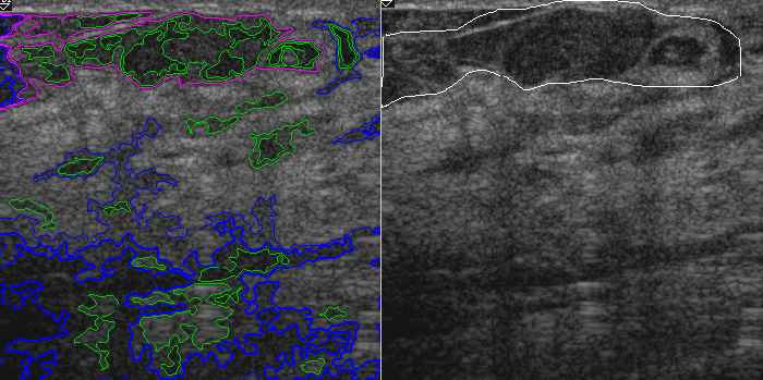 Segmentation of Breast Ultrasound
